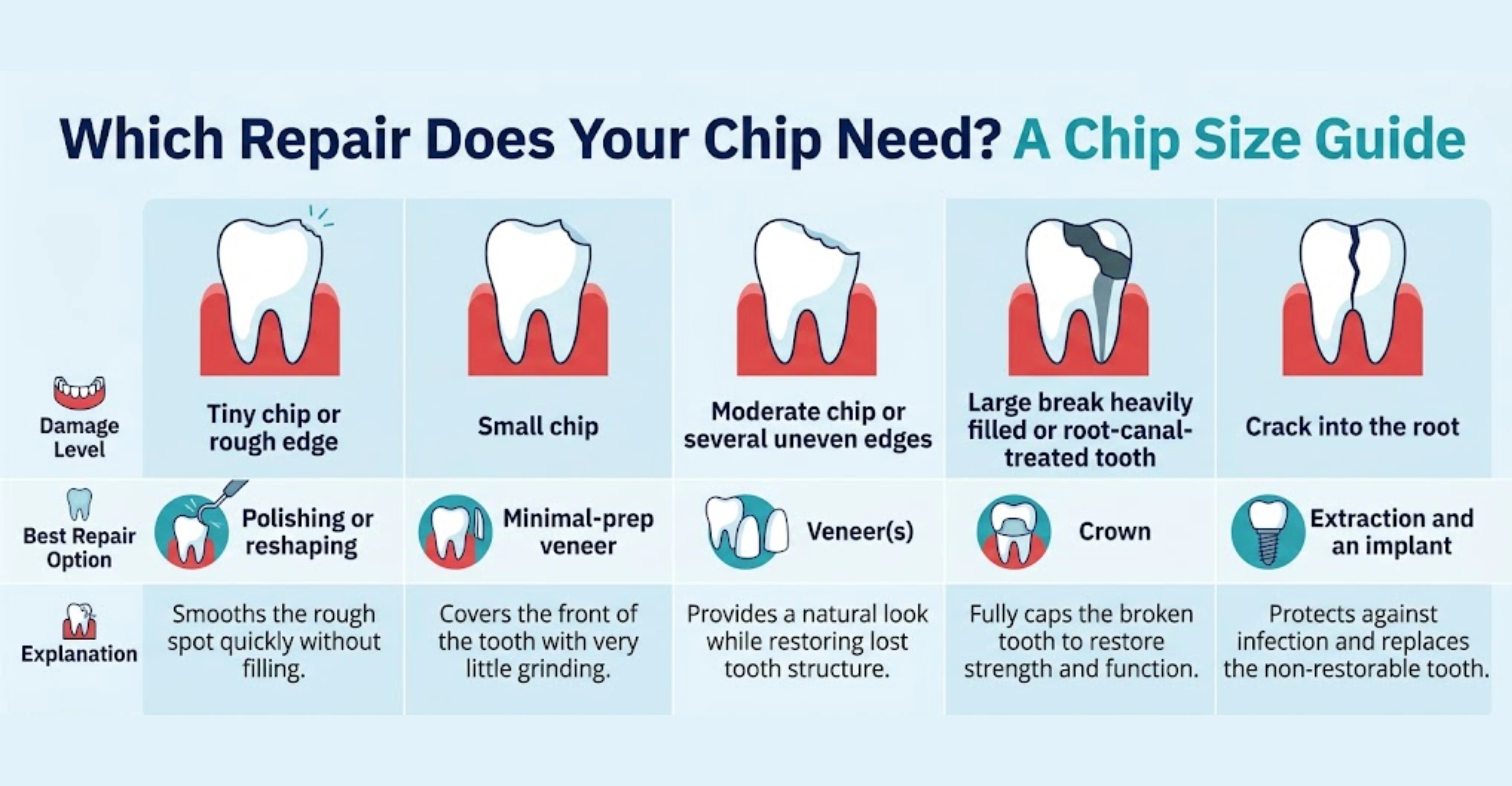 infographic Veneers for Chipped Teeth